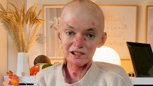 Junge Frau mit EB mit Wunden am Kopf und im Gesicht schaut in die Kamera