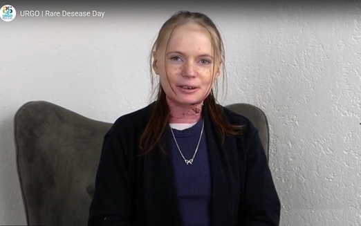 Eine junge Frau mit EB schaut in die Kamera